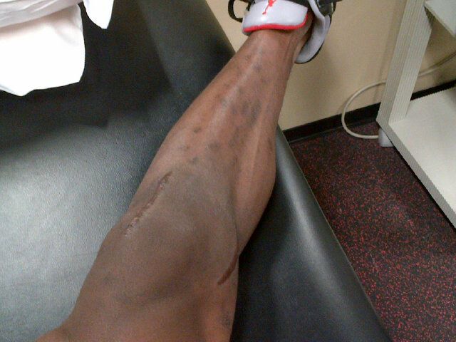 adrian peterson knee picture